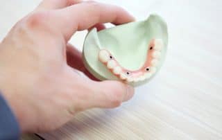 Dental implants on Plaster Cast
