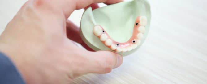 Dental implants on Plaster Cast