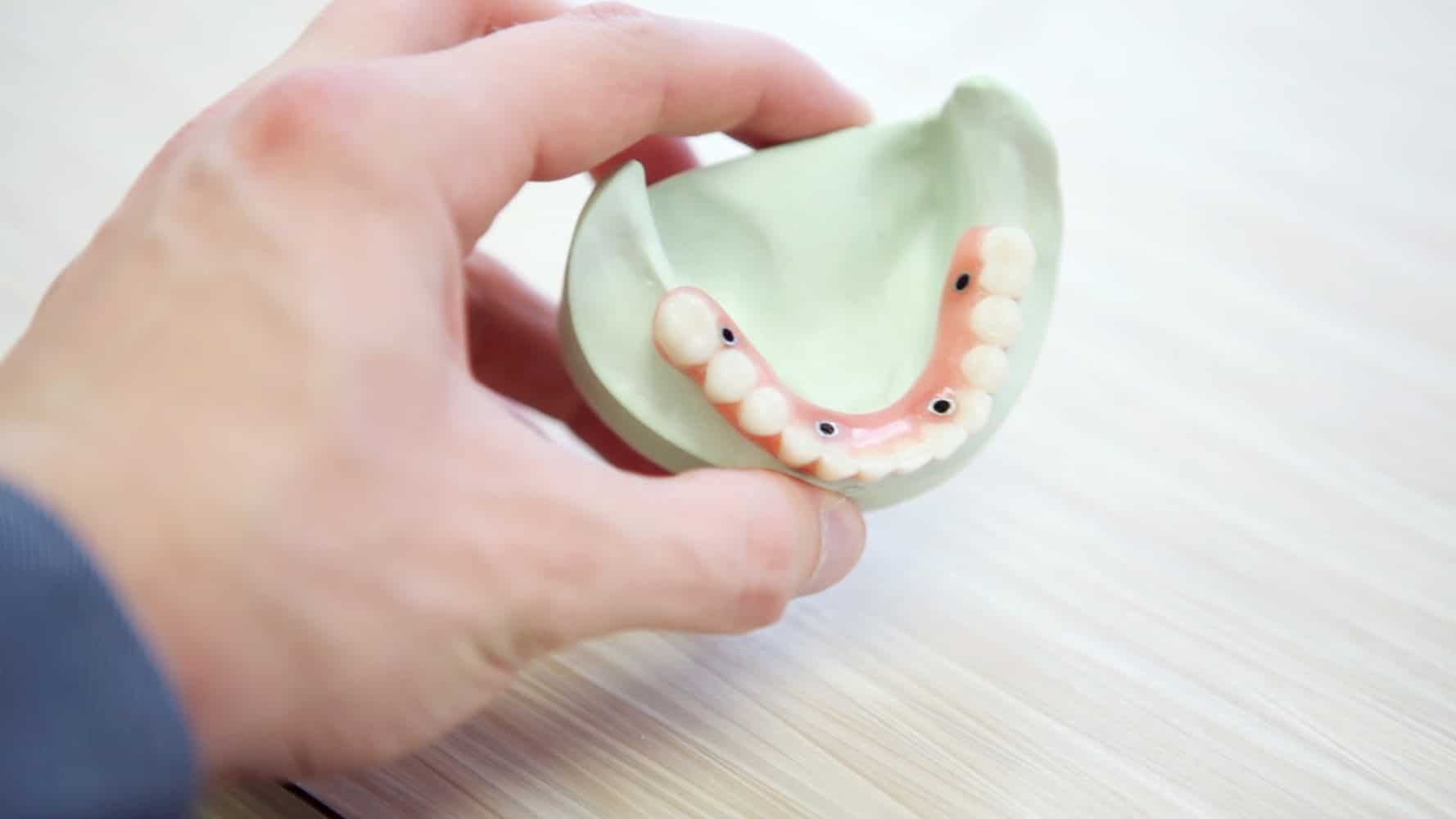 Dental implants on Plaster Cast