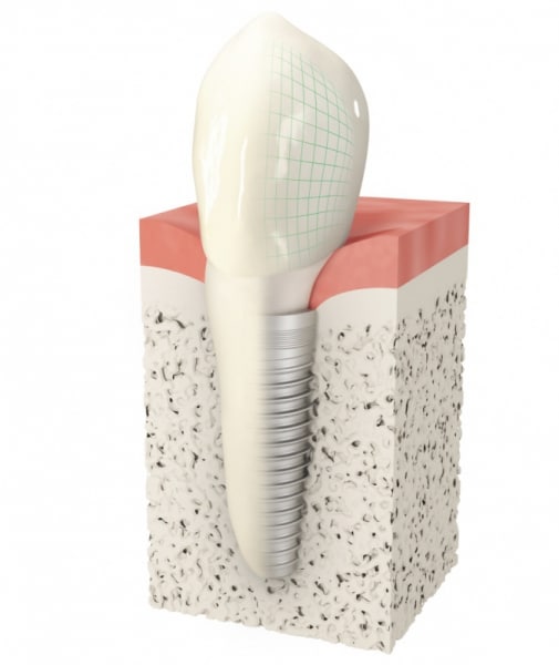 Dental Implant single tooth