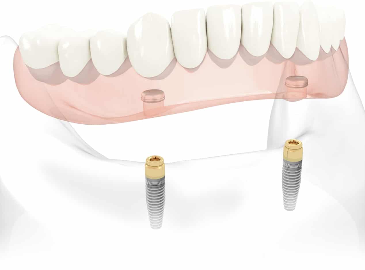 Dental Implants Lower Jaw