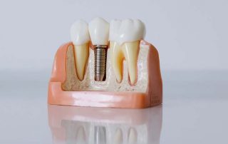 dental-implants-dentist-sunshine-coast