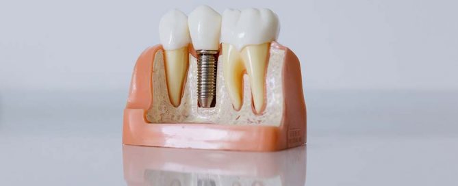 dental-implants-dentist-sunshine-coast