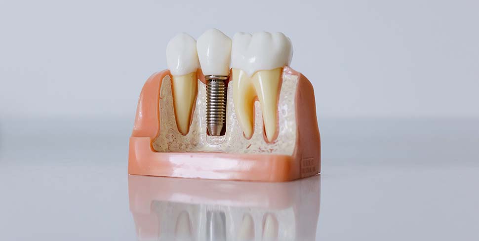 dental-implants-dentist-sunshine-coast