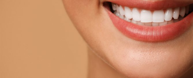 veneers