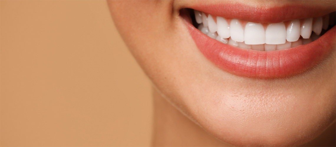 veneers